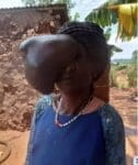 Reprieve for woman with a huge cystic growth on the right side of the face as Moi Teaching and Referal Hospital (MTRH) doctors remove it 1 Beatrice Makokha at her home; before the surgery.